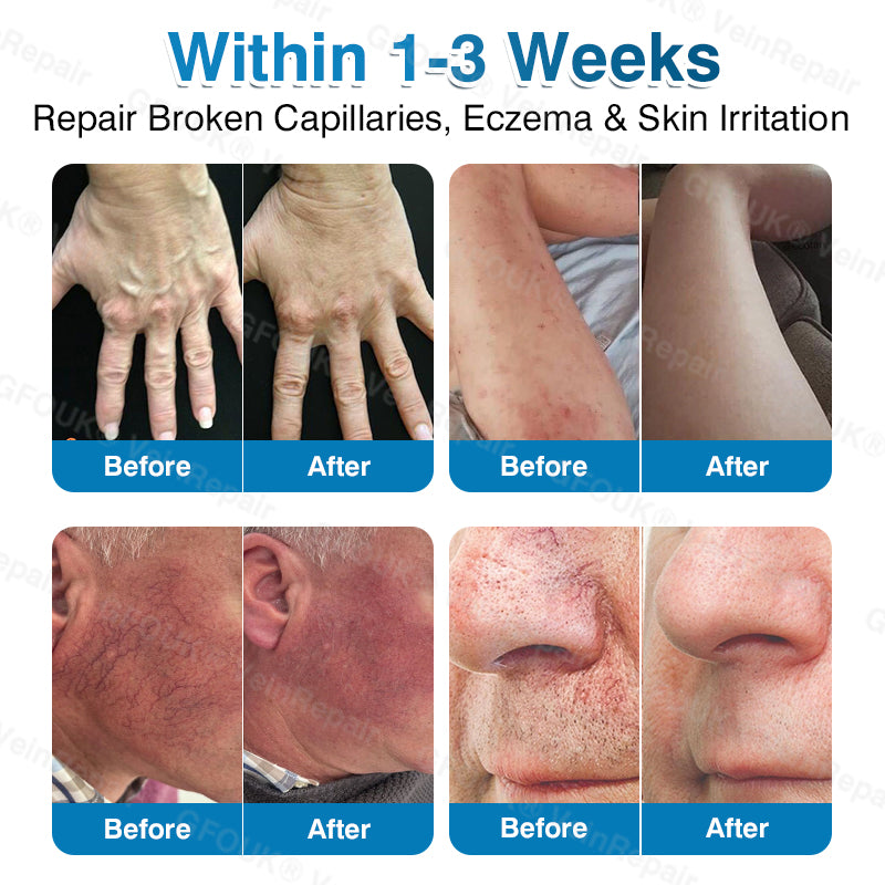 🇬🇧🏆🦵🛡️GFOUK® VeinRepair Microneedle Patch Roll👻Instant Relief, Long-Term Results