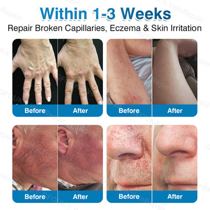 🇬🇧🏆🦵🛡️GFOUK® VeinRepair Microneedle Patch Roll👻Instant Relief, Long-Term Results
