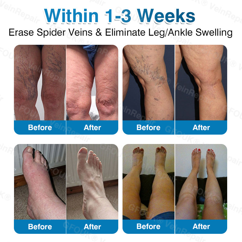 🇬🇧🏆🦵🛡️GFOUK® VeinRepair Microneedle Patch Roll👻Instant Relief, Long-Term Results