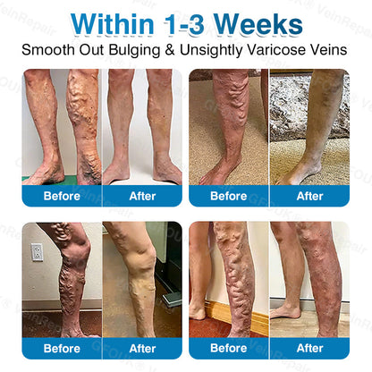 🇬🇧🏆🦵🛡️GFOUK® VeinRepair Microneedle Patch Roll👻Instant Relief, Long-Term Results